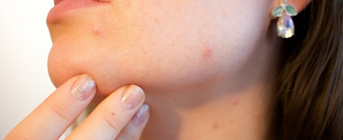 Skin with acne